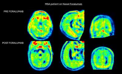 Tiziana Reports Reduction in Brain Inflammation in Third Multiple System Atrophy Patient Treated with Intranasal Foralumab