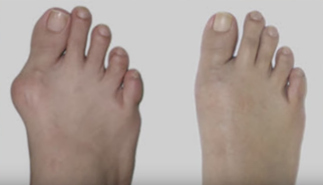 bunions