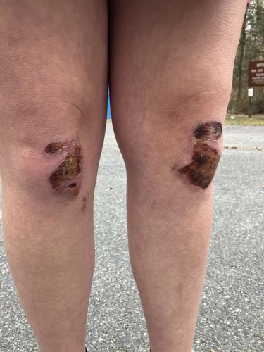 Scraped Knees