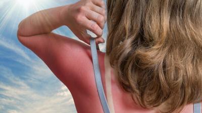 Best Way To Soothe Sunburn & Limit Peeling: Proven Post-Sun Relief & Recovery