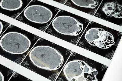 How Long Does Contrast Dye Stay in Your System? CT Scan Side Effects Explained