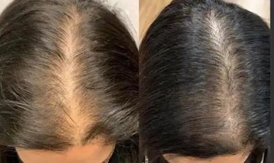 KeraLase Hair Restoration Now Available in Suffern, NY