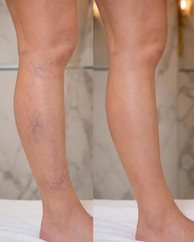 Nouveau Dermé Aesthetic Centre Expands Spider Vein Treatment Program