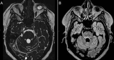 Chinese Neurosurgical Journal Reports Novel Surgical Approach for Refractory MS-Related Trigeminal Neuralgia