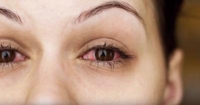 Paid Content by Chesapeake Eye Center Dry Eyes YouTube