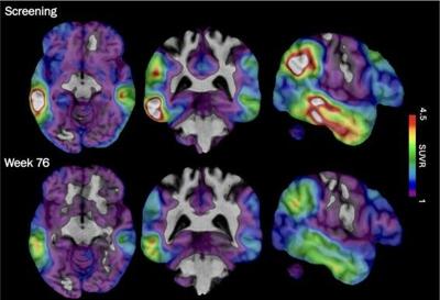 Alzheimers New Experimental Drugs