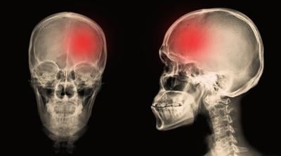 Primary Care Plays a Practical Role in Managing Migraine Treatment