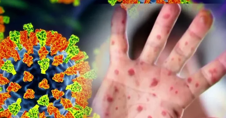 Delaware confirms second measles case, both in Kent County - WDEL