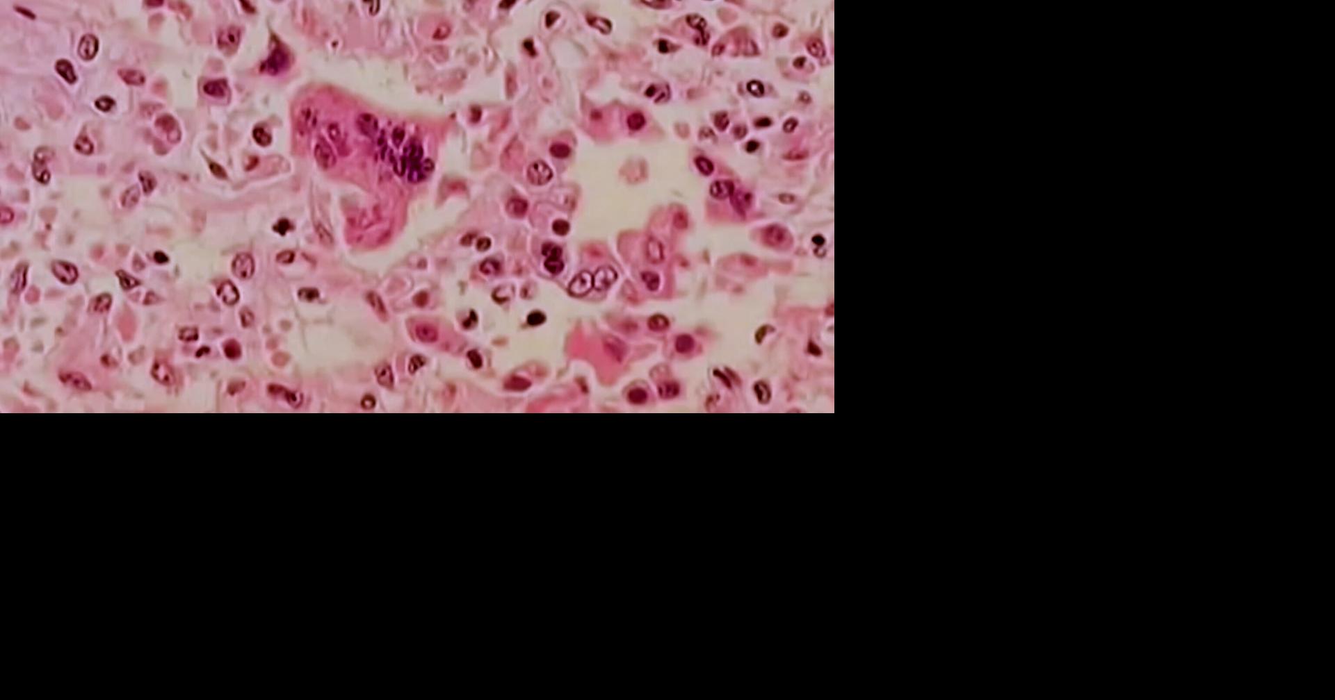 Delaware's 4 new cases of measles meet criteria of "outbreak" - WDEL