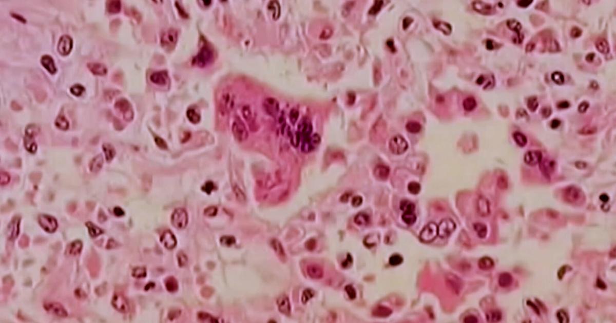 Delaware's 4 new cases of measles meet criteria of "outbreak" - WDEL