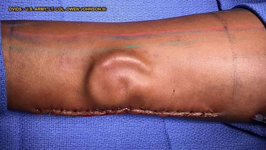Ear Growing on Arm