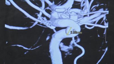 Stroke treatment via wridst