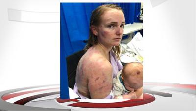 Mom in Australia horribly bruised shielding baby from softball-sized hailstones
