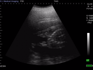Bibi ultrasound