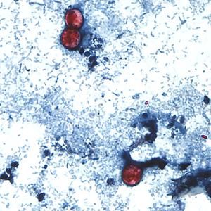 Michigan reports first 2 US deaths in outbreak of cyclospora