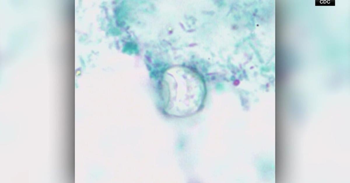 Cyclospora reported in 6 more states, bringing total to 15