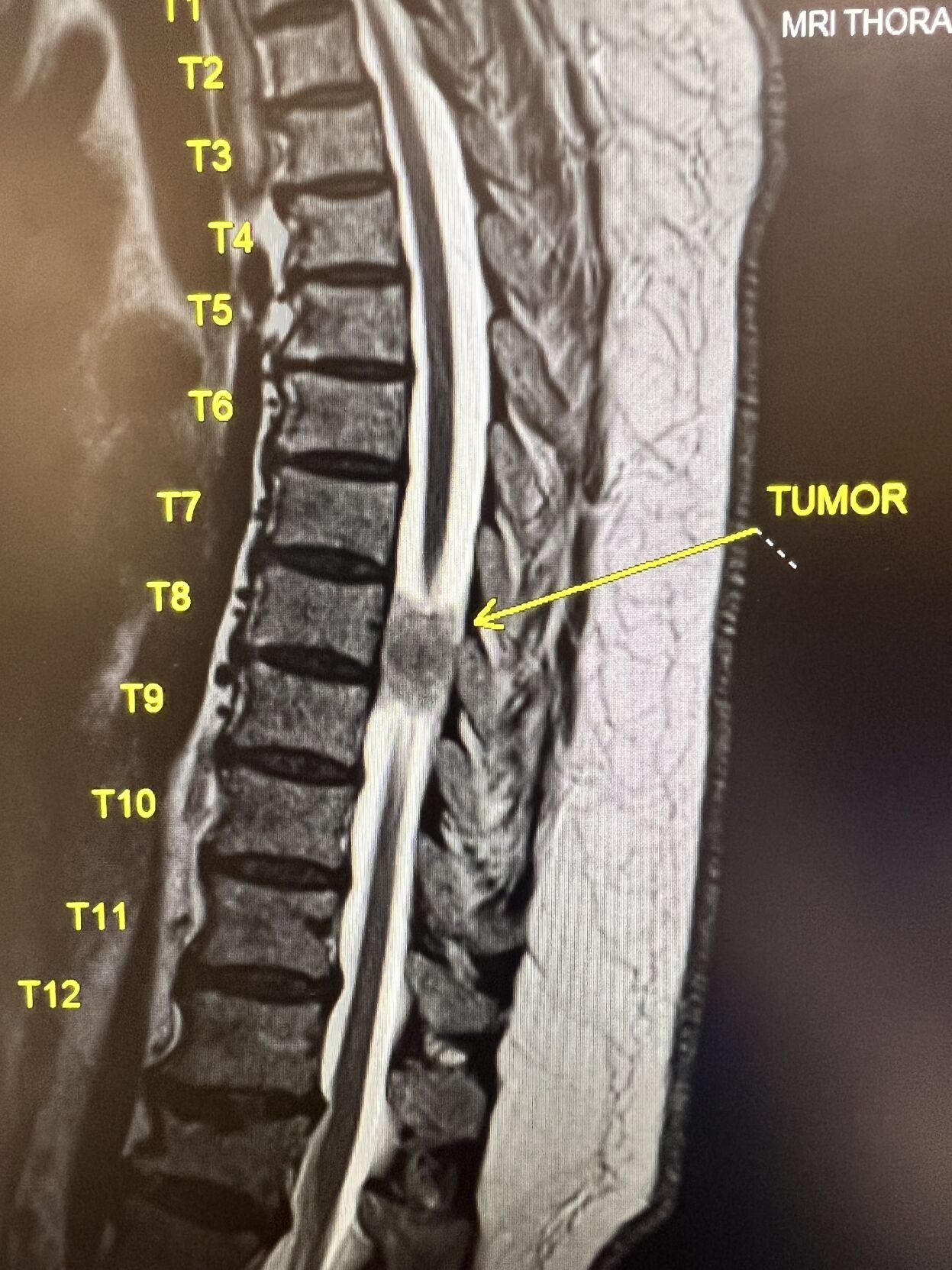 PICTURE OF HUGHEY'S SPINAL TUMOR
