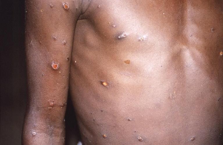 MONKEYPOX - AFRICA - AP
