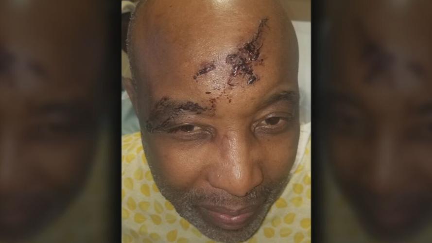 David Weaver injuries from dog attack