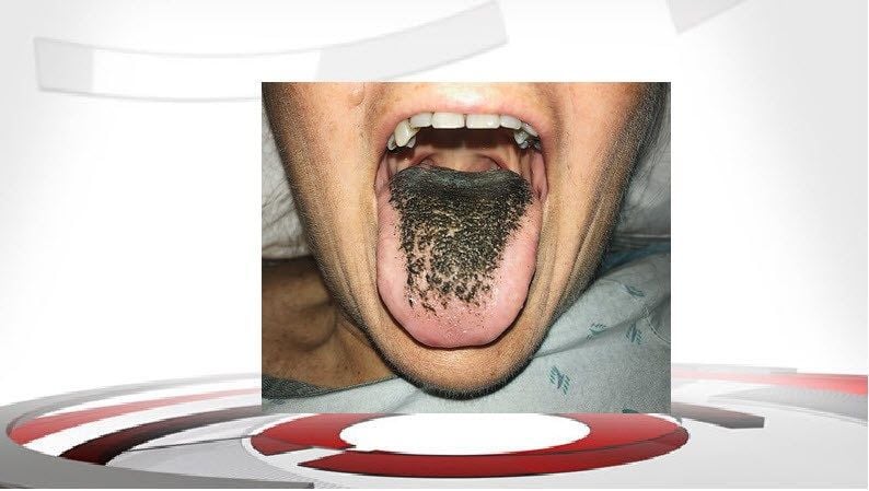 Patient develops 'black hairy tongue' after taking antibiotics | Local News 
