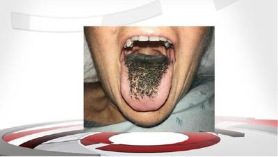 Patient develops 'black hairy tongue' after taking antibiotics