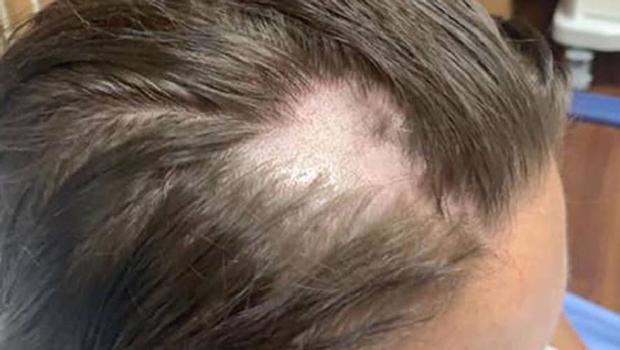Wisconsin woman loses hair 8-7-19