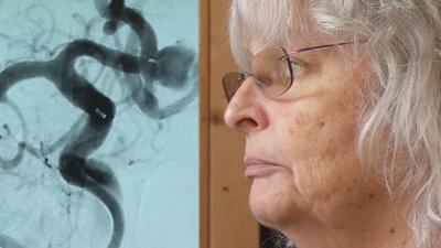 Brain Aneurysms with patient Mary Steinhilber