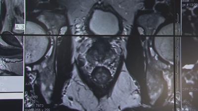 Medical image of a patient's prostate