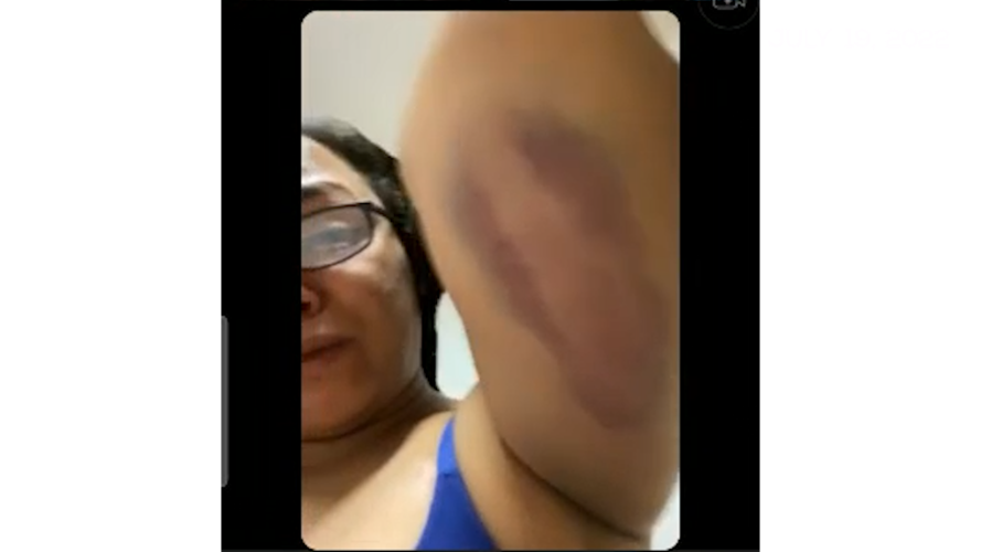 Denisha bruise