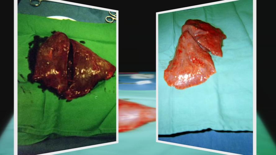 Mike Olsen lung transplant old-vs-new lungs