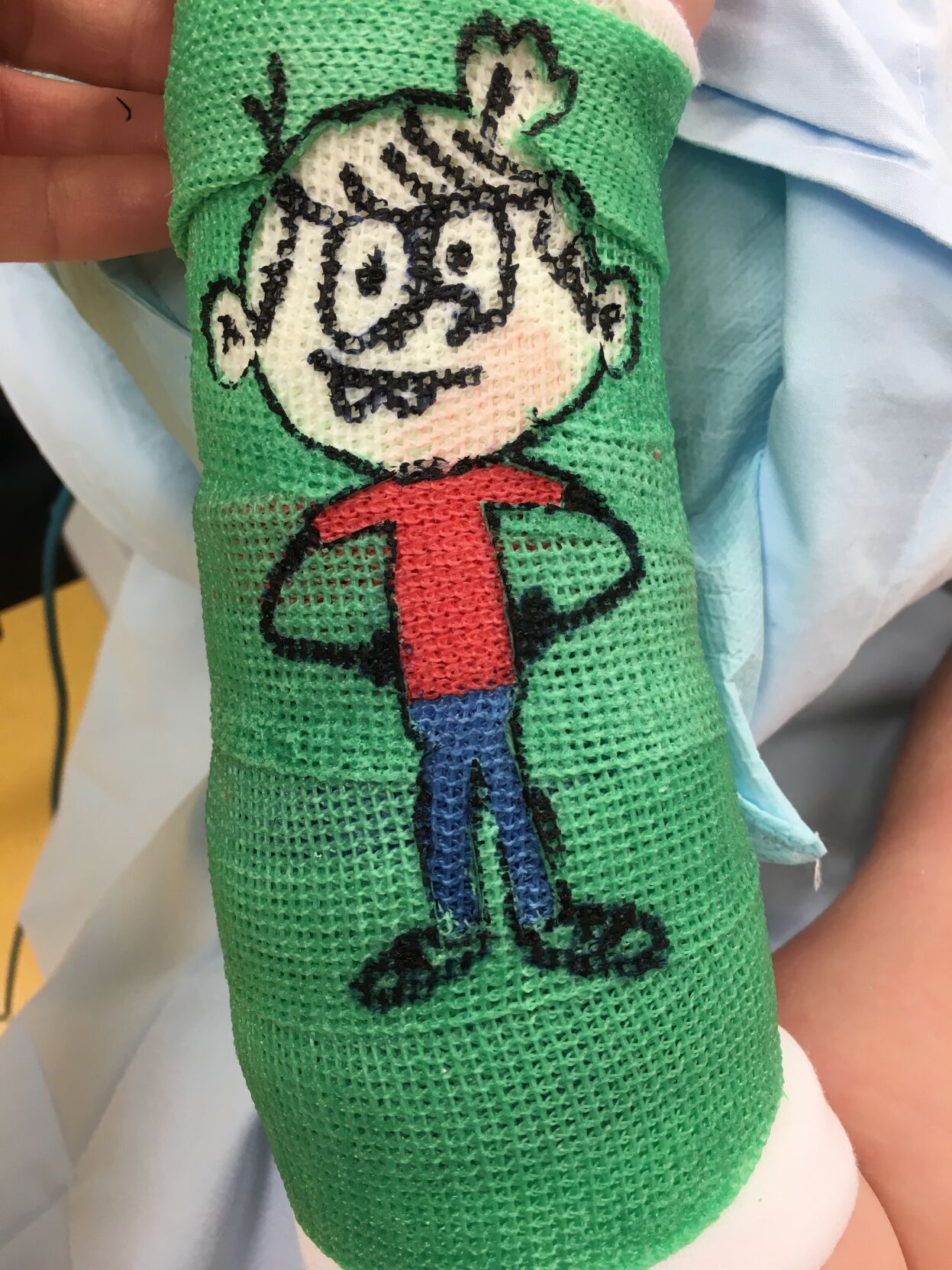 Carving in cast by Dr. Laura Jacks