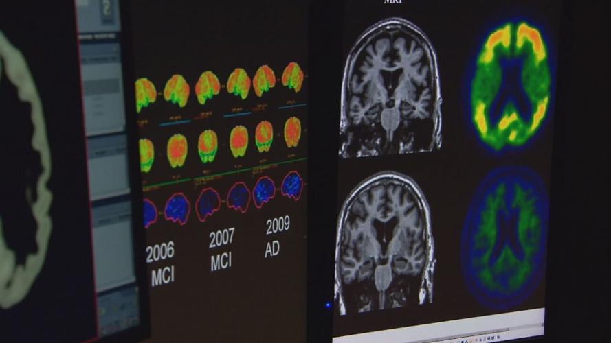 Alzheimer's disease