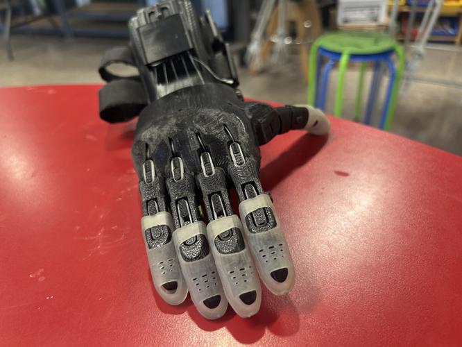 Glasgow boy with 3D hand