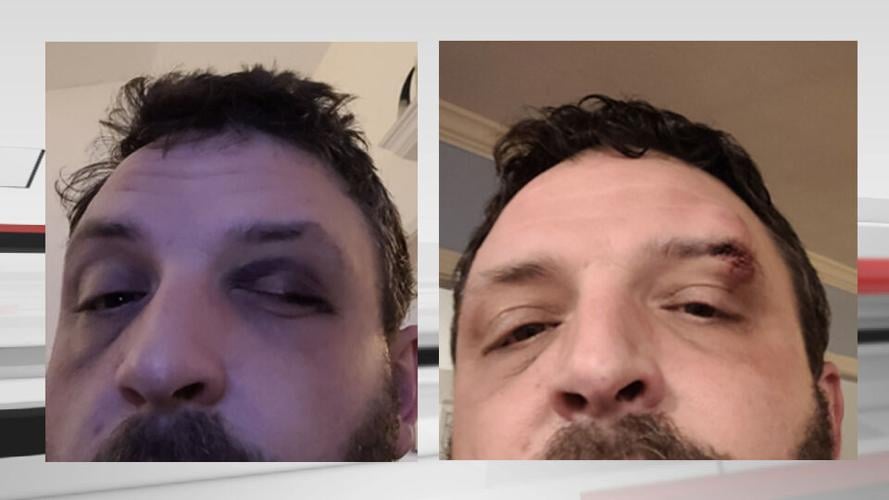 Injuries Joseph Bennett says he sustained after he was "sucker punched" by Jeffersontown Police officer Manuel Cruz.