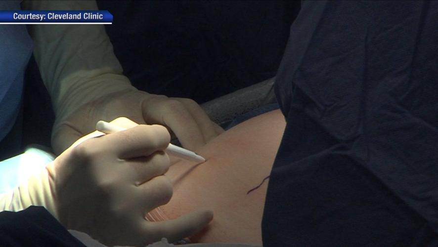 In Uerto Surgery from Cleveland Clinic via Fox News