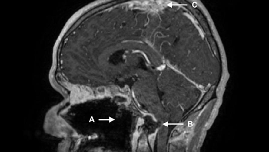 Cocaine Throat MRI