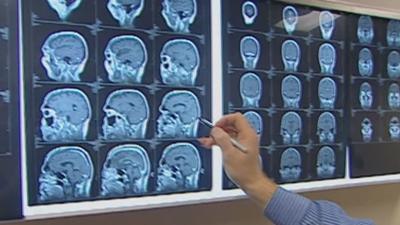 Stress might lead to brain shrinkage, memory loss study says