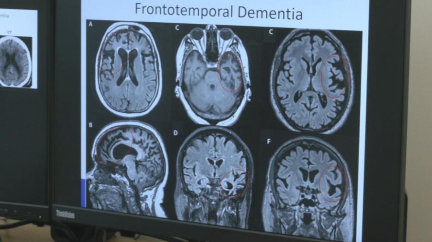 ALZHEIMERS Brain scan
