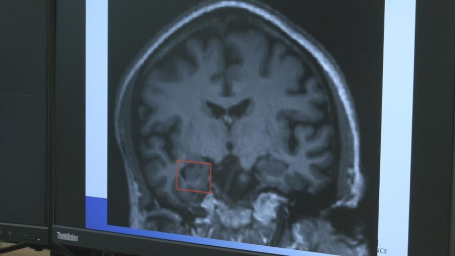 ALZHEIMERS