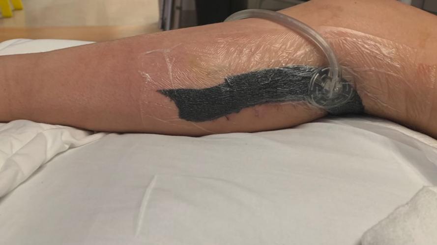 IN FLESH EATING BACTERIA GIRL FIRST STEPS KYLEI  7-3-19  (3).jpg