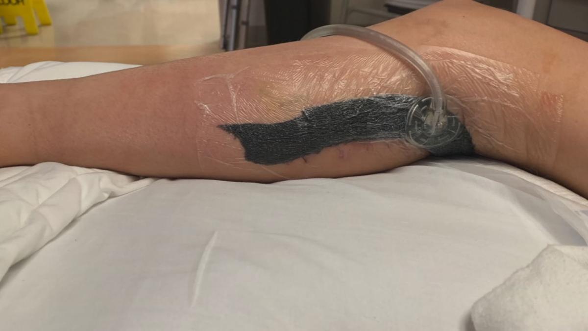 Indiana Girl Contracts Flesh Eating Disease During Florida Vacation News Wdrb Com