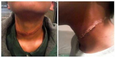 Texas jury awards $68K to family of girl burned on neck by rope