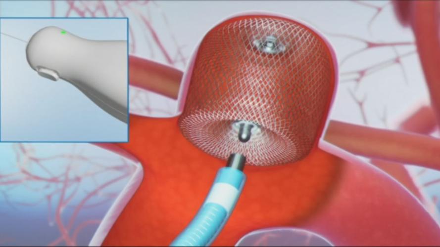 WEB device used to treat aneurysms