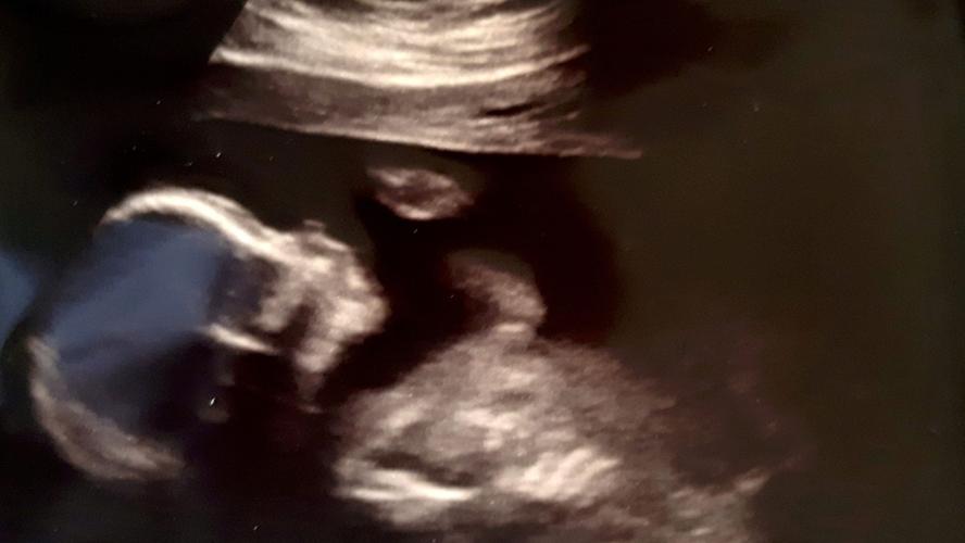 Hayley Sexton ultrasound