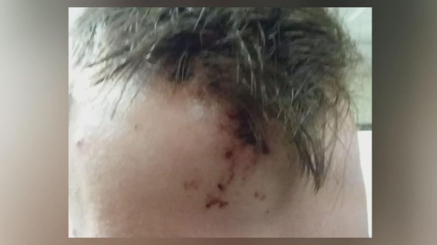 Morgenn Evans Forehead grazed