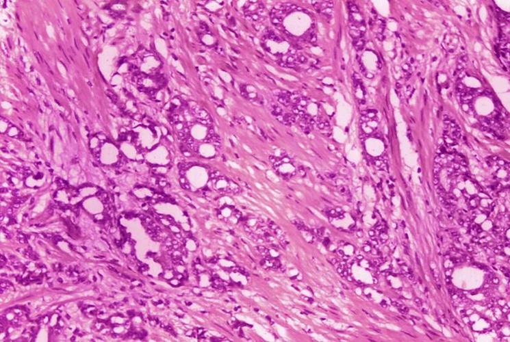 CANCER CELLS - AP FILE.jpeg