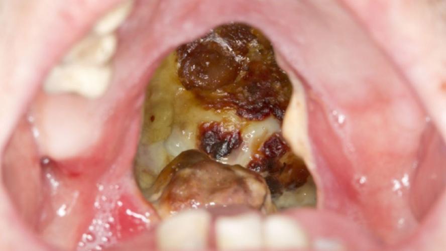 Cocaine Throat Erosion Image - Graphic