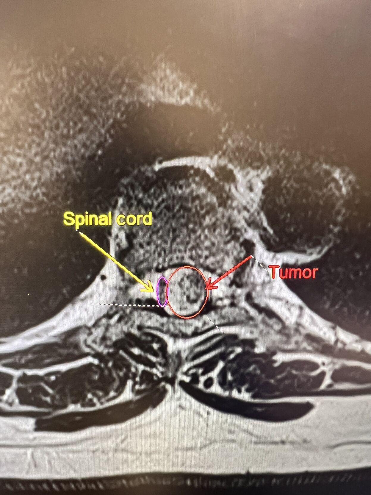 IMAGE OF HUGHEY'S SPINAL TUMOR