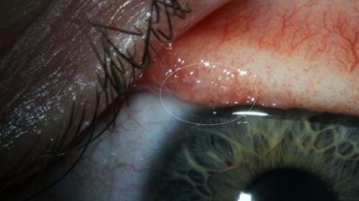 Oregon woman has 14 worms pulled from eye after rare infection