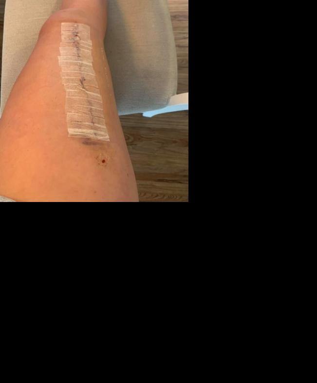 Alexis Carrico surgery 4.jpg